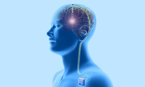 Vagus Nerve Stimulation (VNS) Surgery